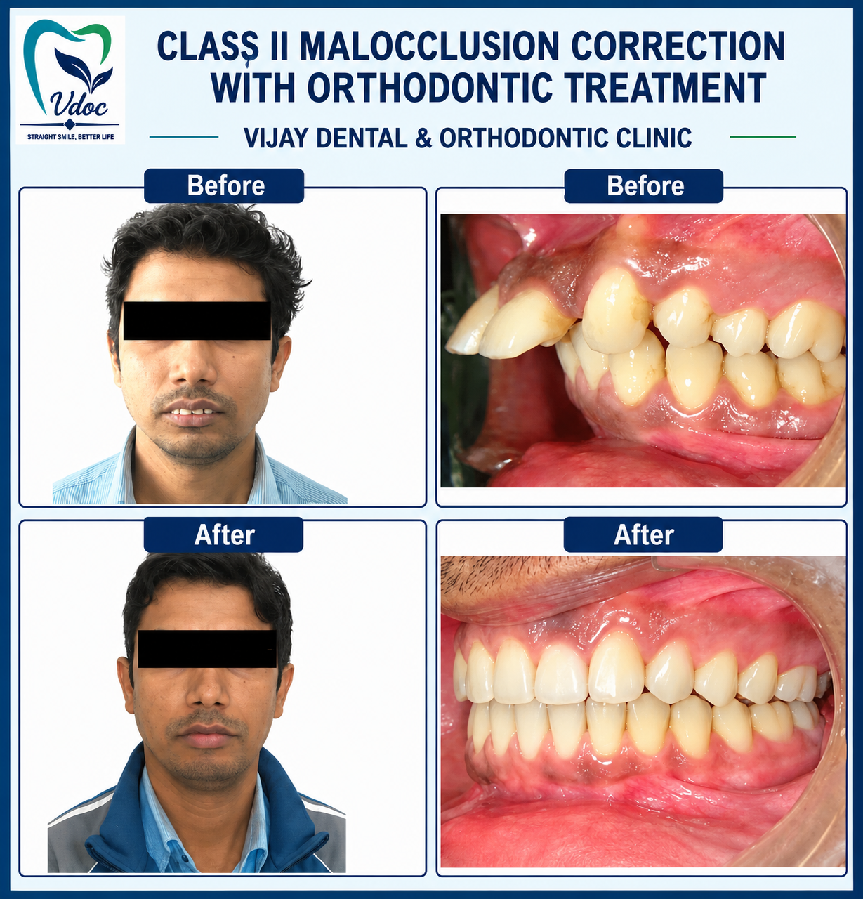 Class II malocclusion correction with Orthodontic treatment at Vijay Dental & Orthodontic Clinic