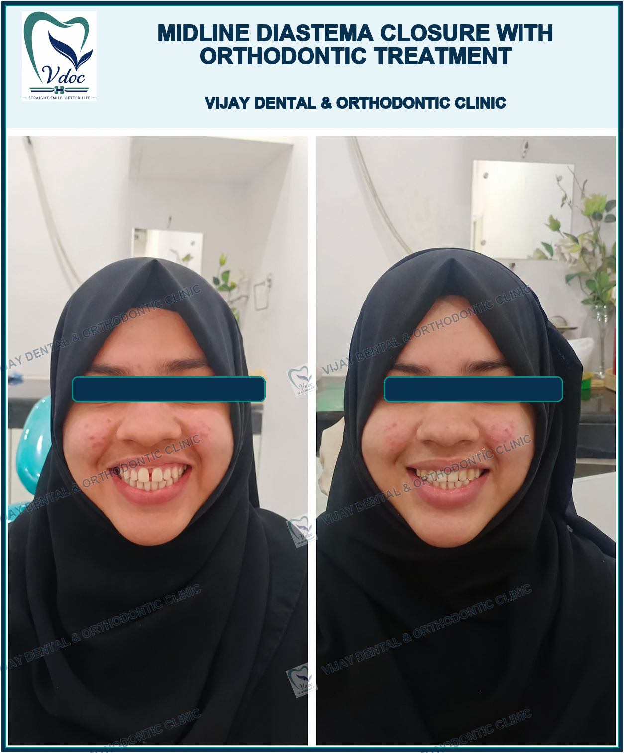 Midline diastema closure with Orthodontic treatment at Vijay Dental & Orthodontic Clinic