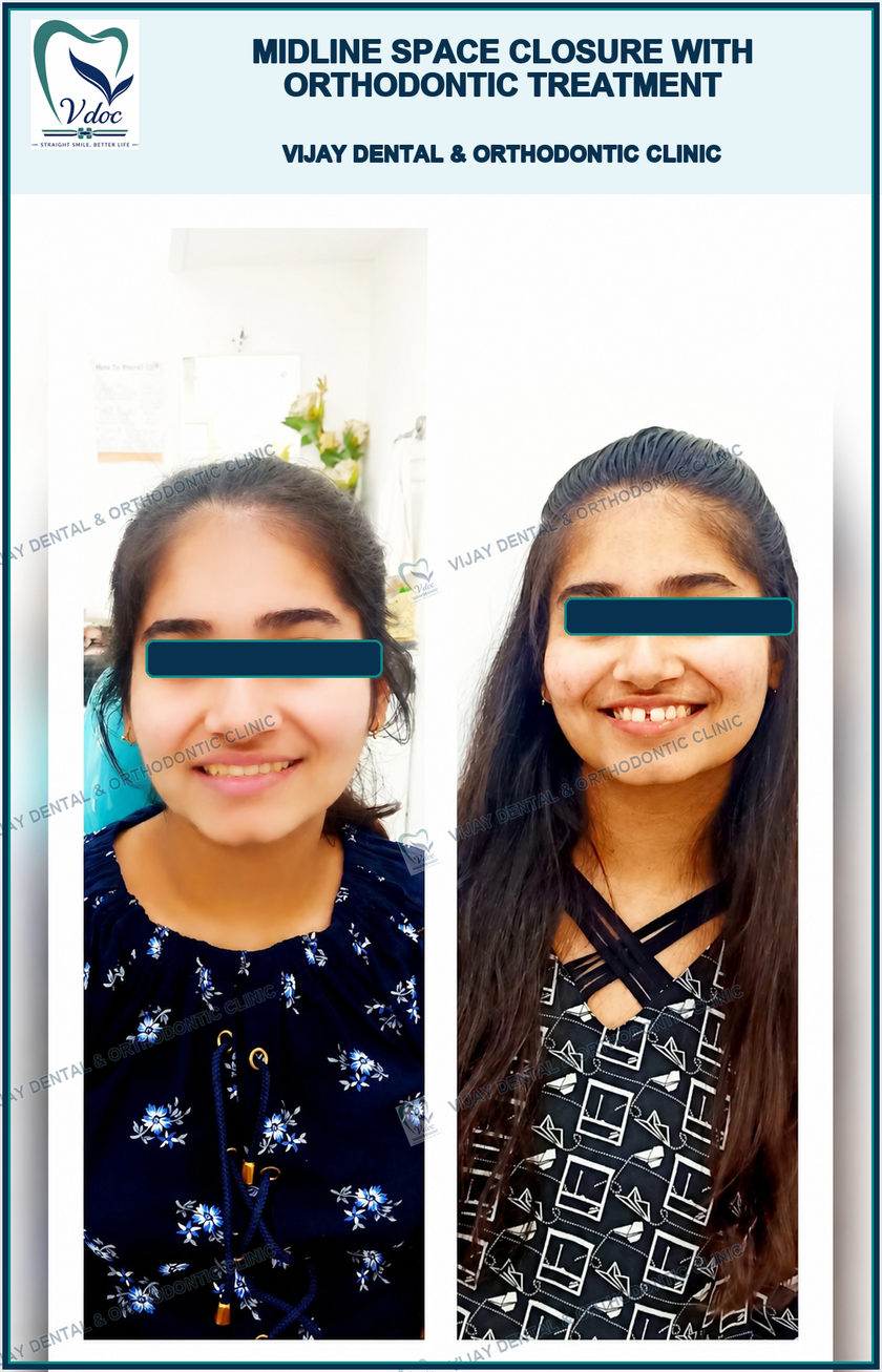 Midline space closure with Orthodontic treatment at Vijay Dental & Orthodontic Clinic