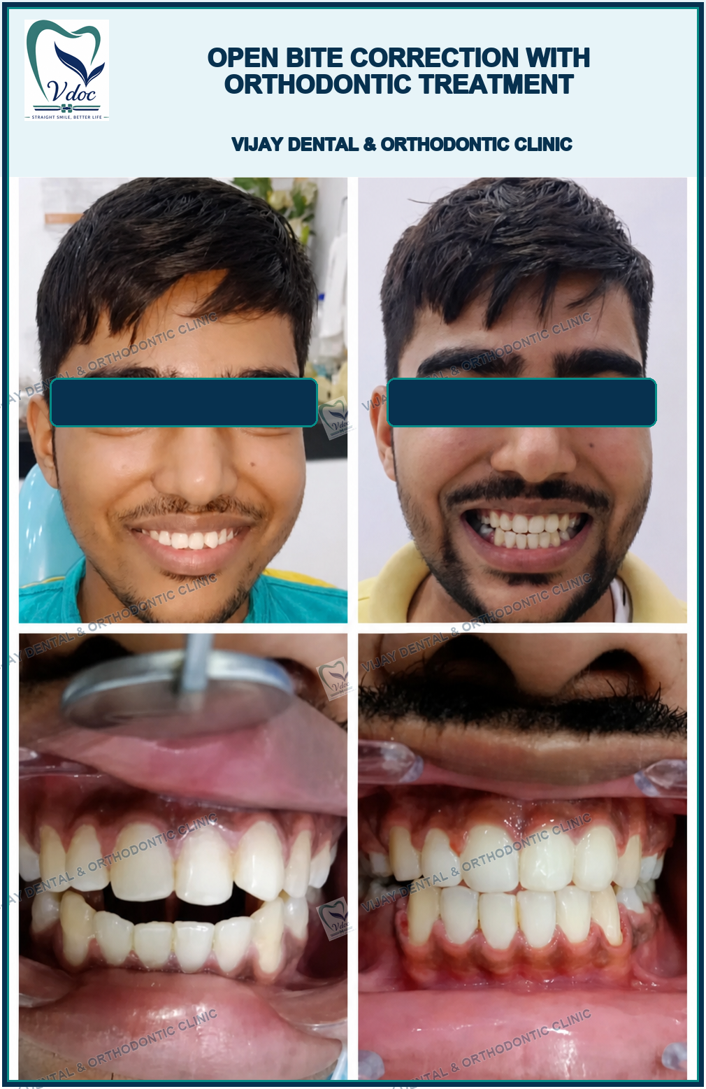 Open bite correction with Orthodontic treatment at Vijay Dental & Orthodontic Clinic