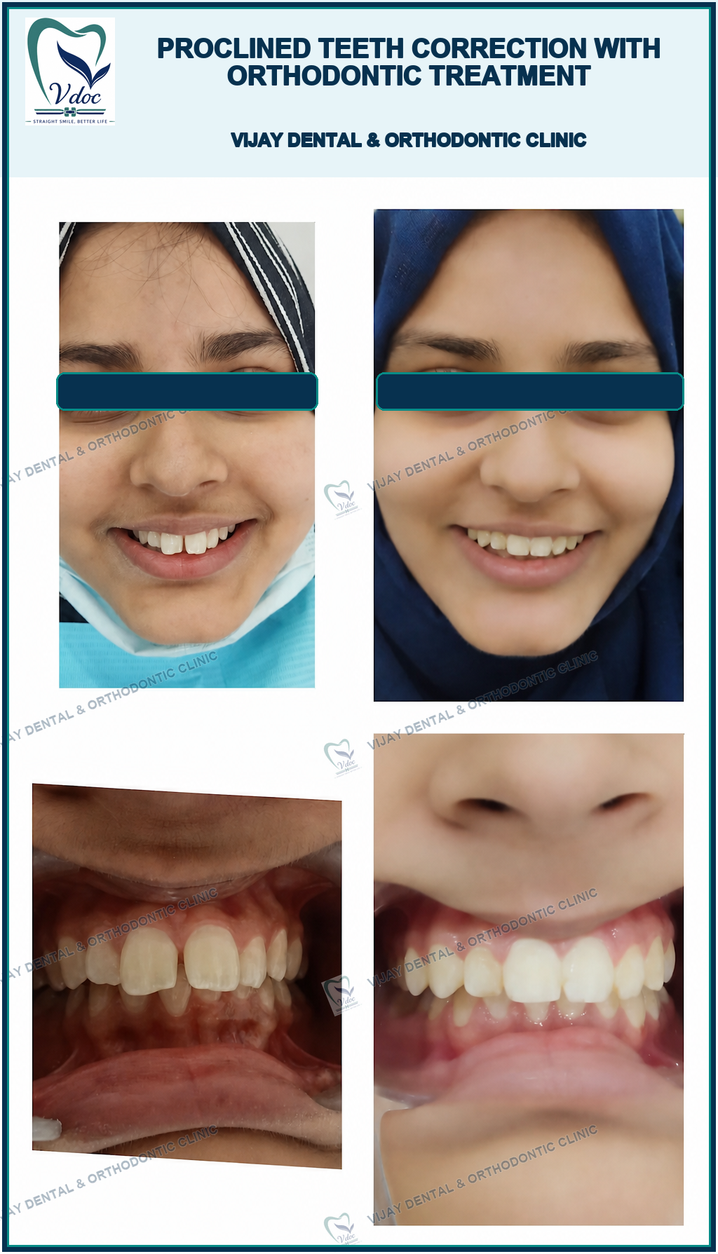 Proclined teeth correction with Orthodontic treatment at Vijay Dental & Orthodontic Clinic