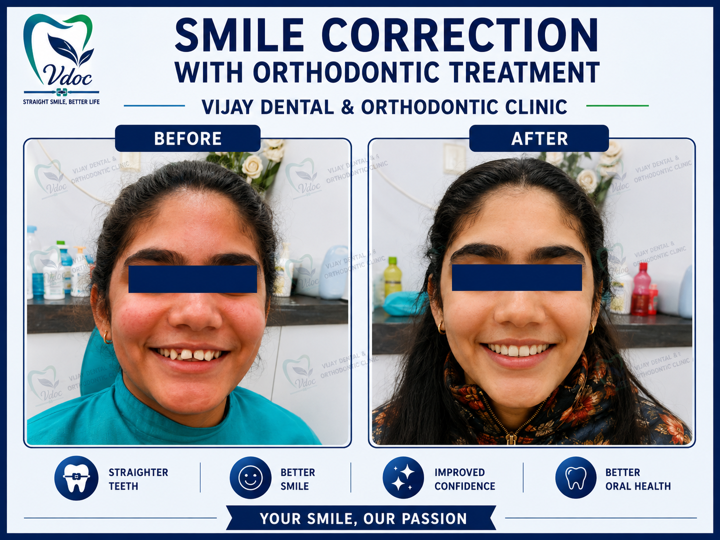 Smile correction with Orthodontic treatment at Vijay Dental & Orthodontic Clinic
