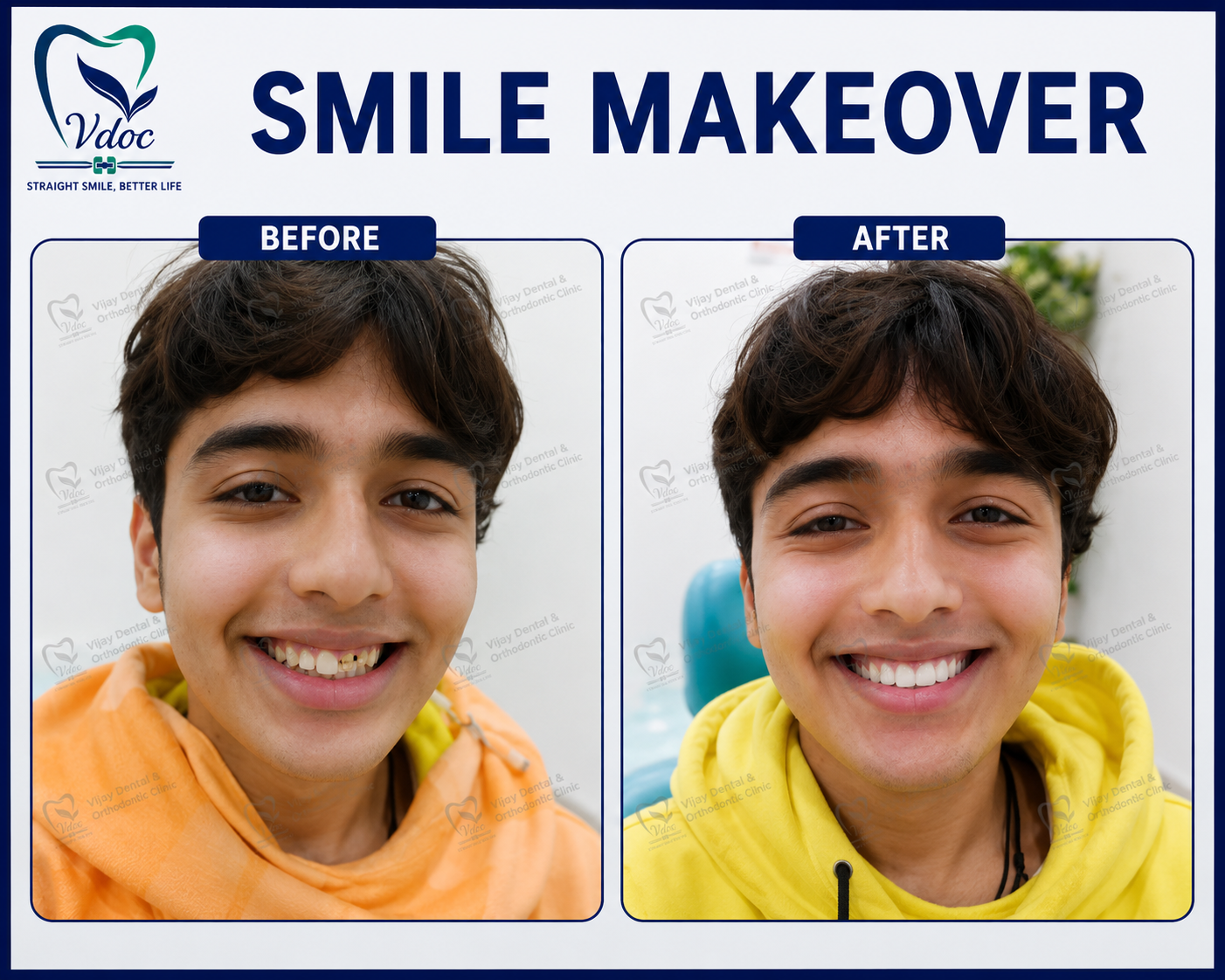 Smile makeover with Orthodontic treatment at Vijay Dental & Orthodontic Clinic
