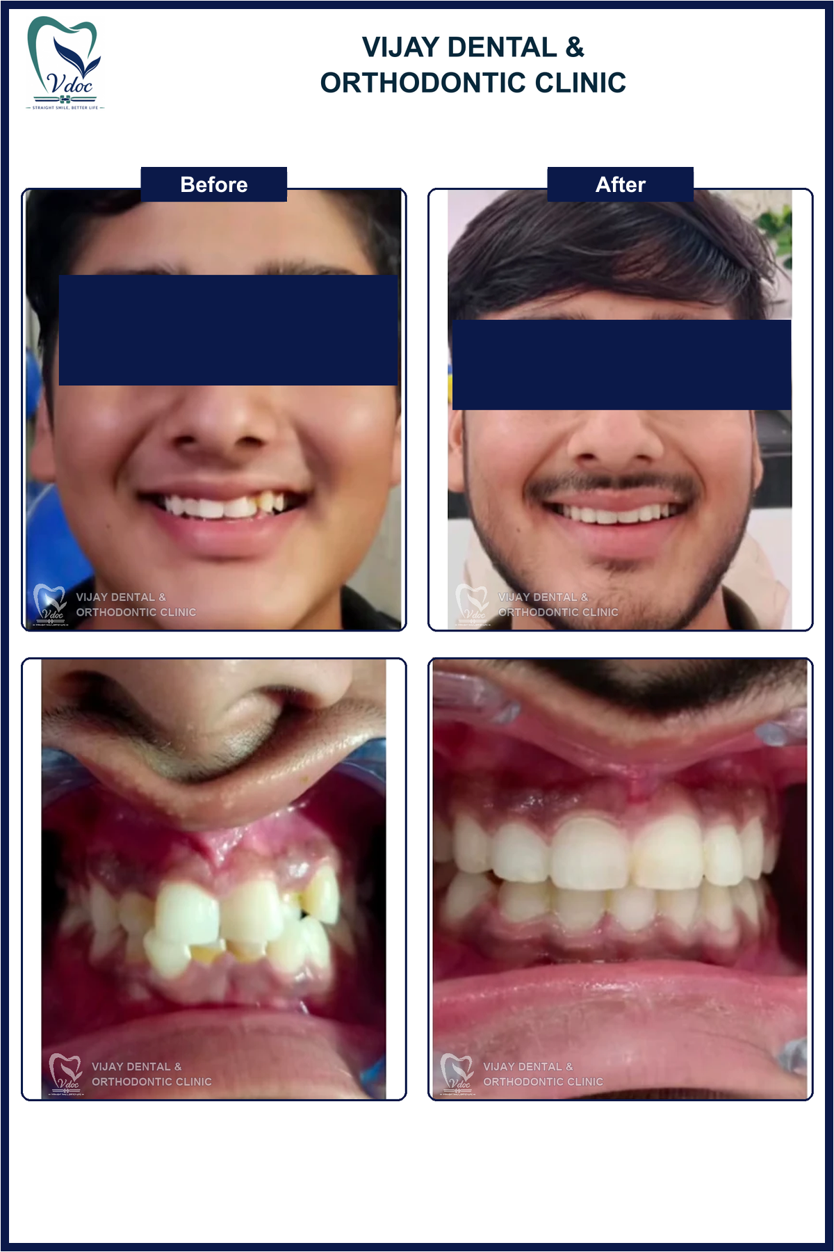 Pre and post orthodontic correction of crowding with cross bite at Vijay Dental and Orthodontic Clinic