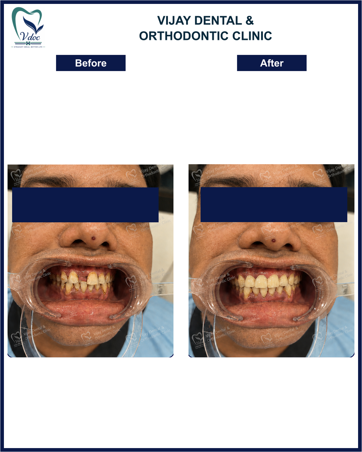 Pre and post dental crown treatment at Vijay Dental and Orthodontic Clinic