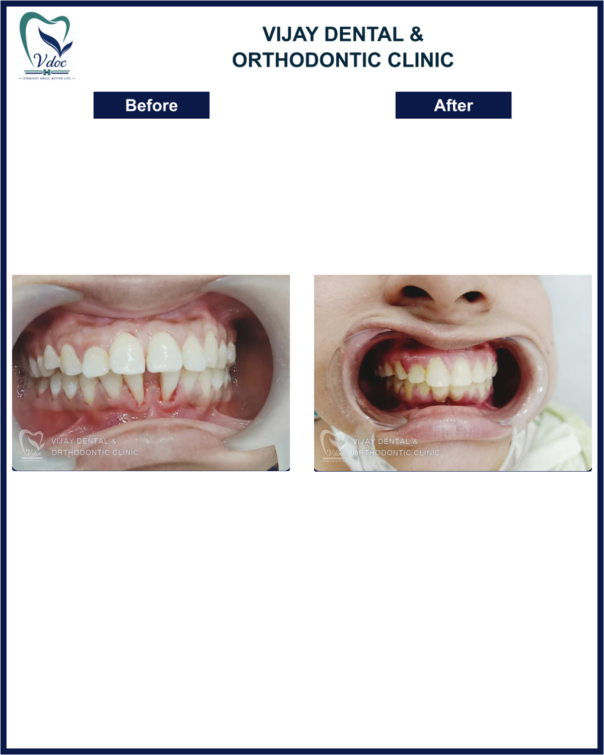 Pre and post smile transformation with dental veneers at Vijay Dental and Orthodontic Clinic