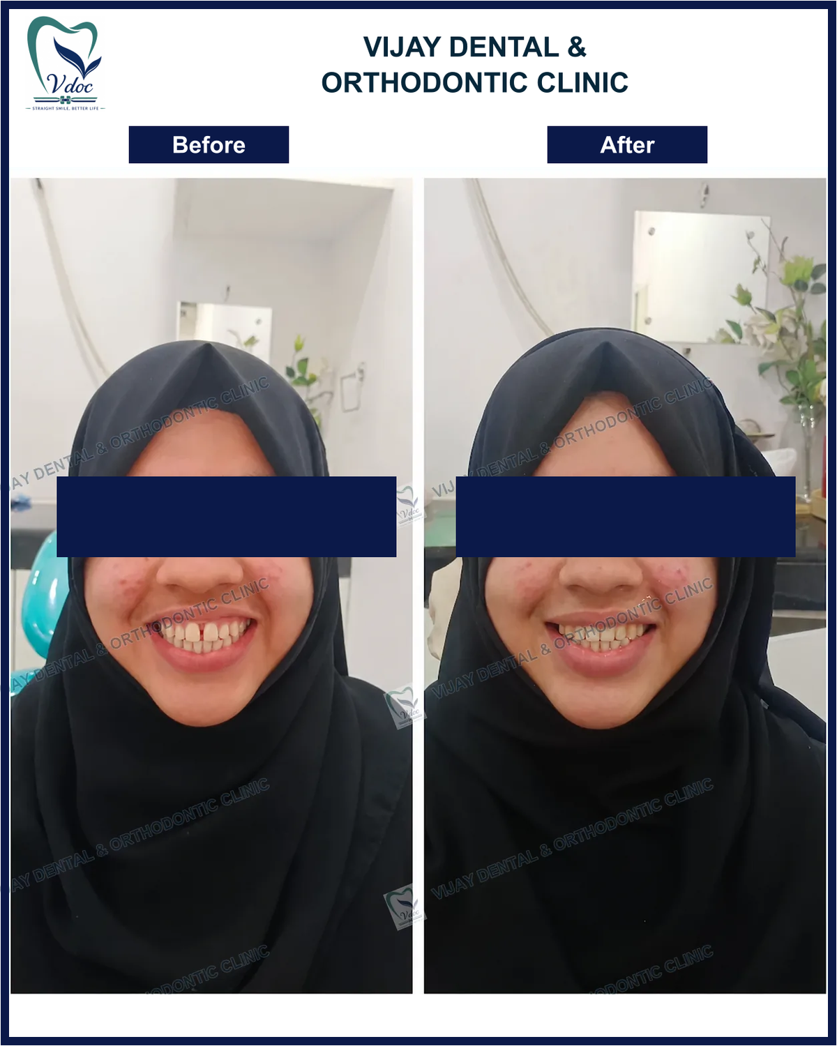 Pre and post midline diastema closure at Vijay Dental and Orthodontic Clinic