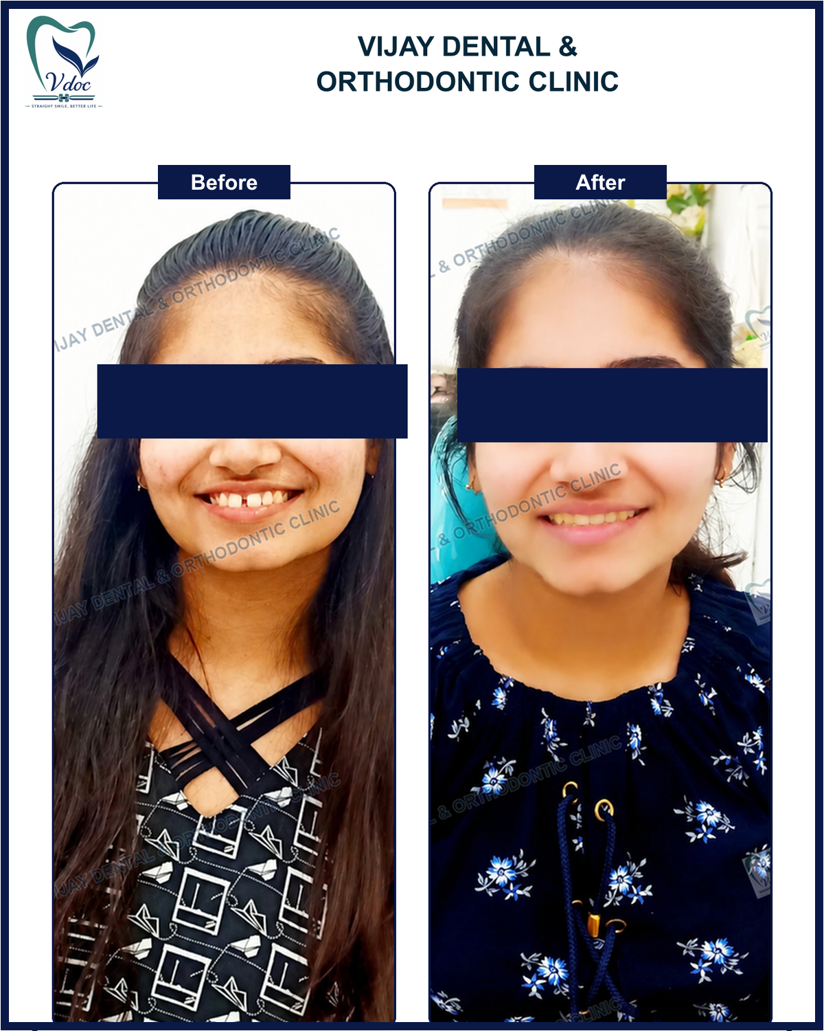 Pre and post midline space closure at Vijay Dental and Orthodontic Clinic