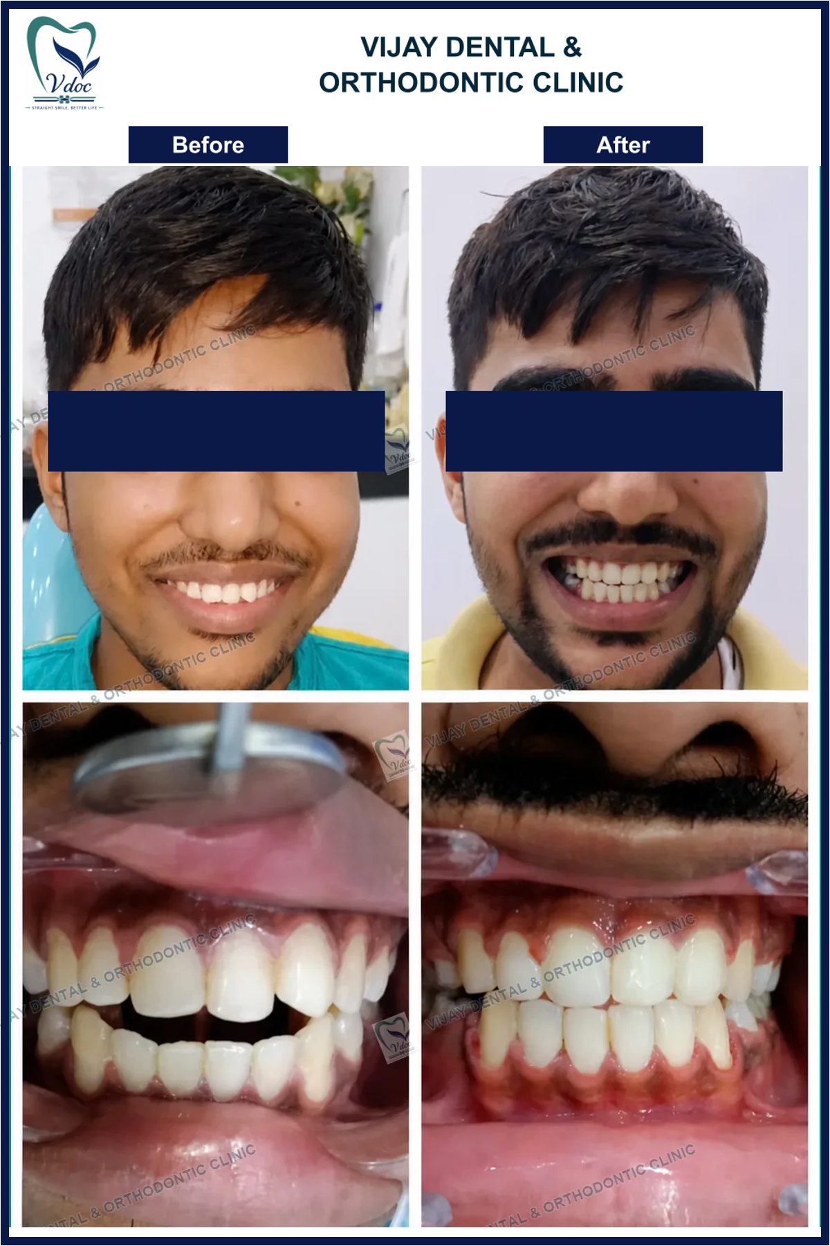 Pre and post open bite correction at Vijay Dental and Orthodontic Clinic
