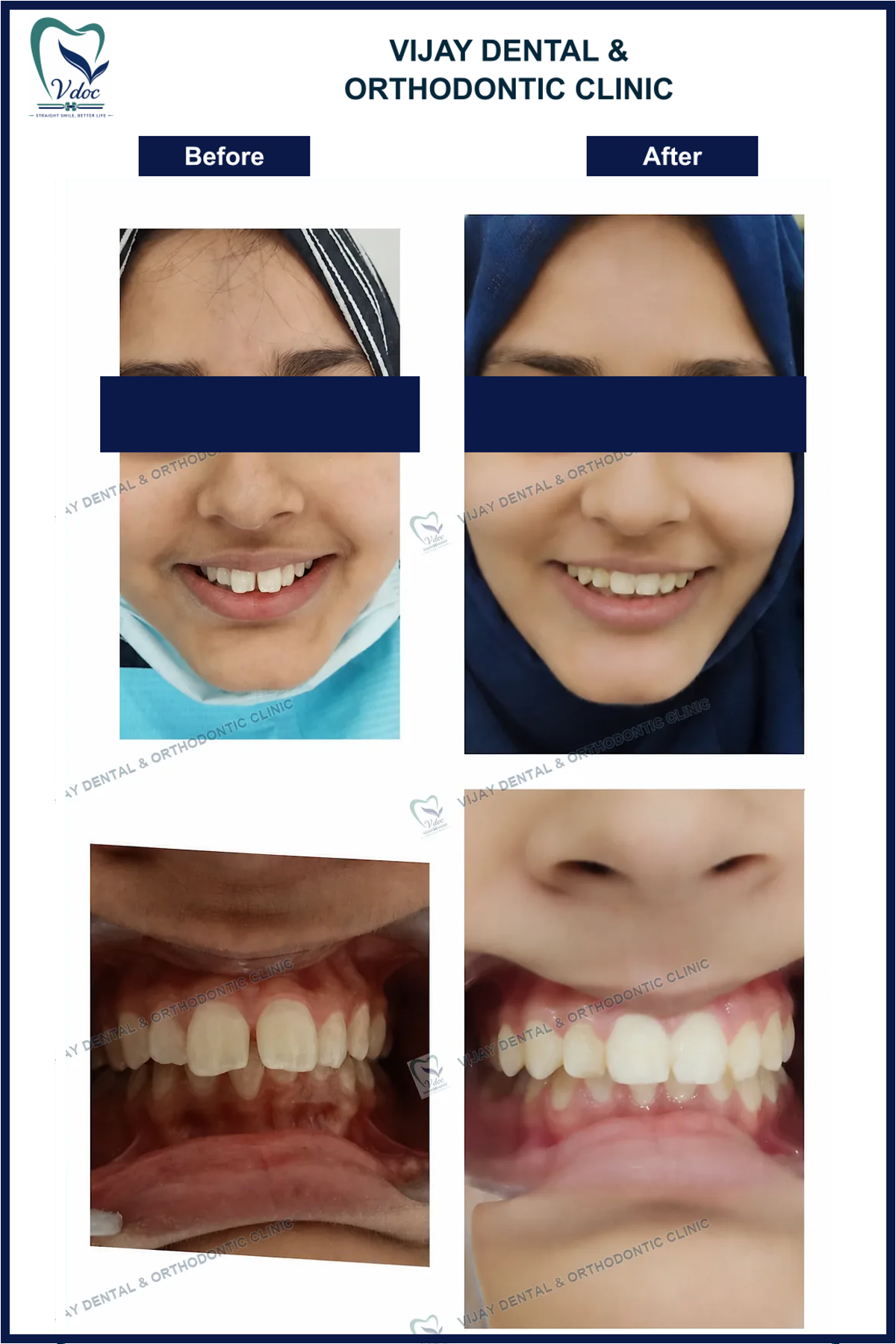 Pre and post proclined teeth correction at Vijay Dental and Orthodontic Clinic