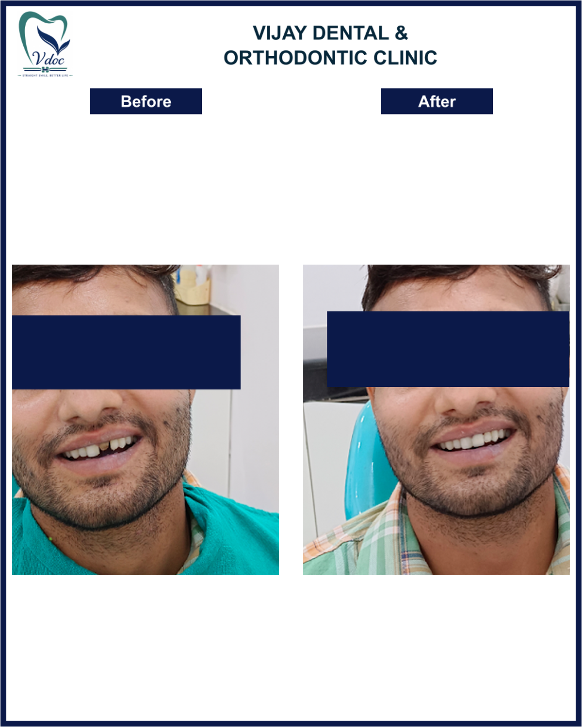 Pre and post rct with dental crown of central incisor at Vijay Dental and Orthodontic Clinic