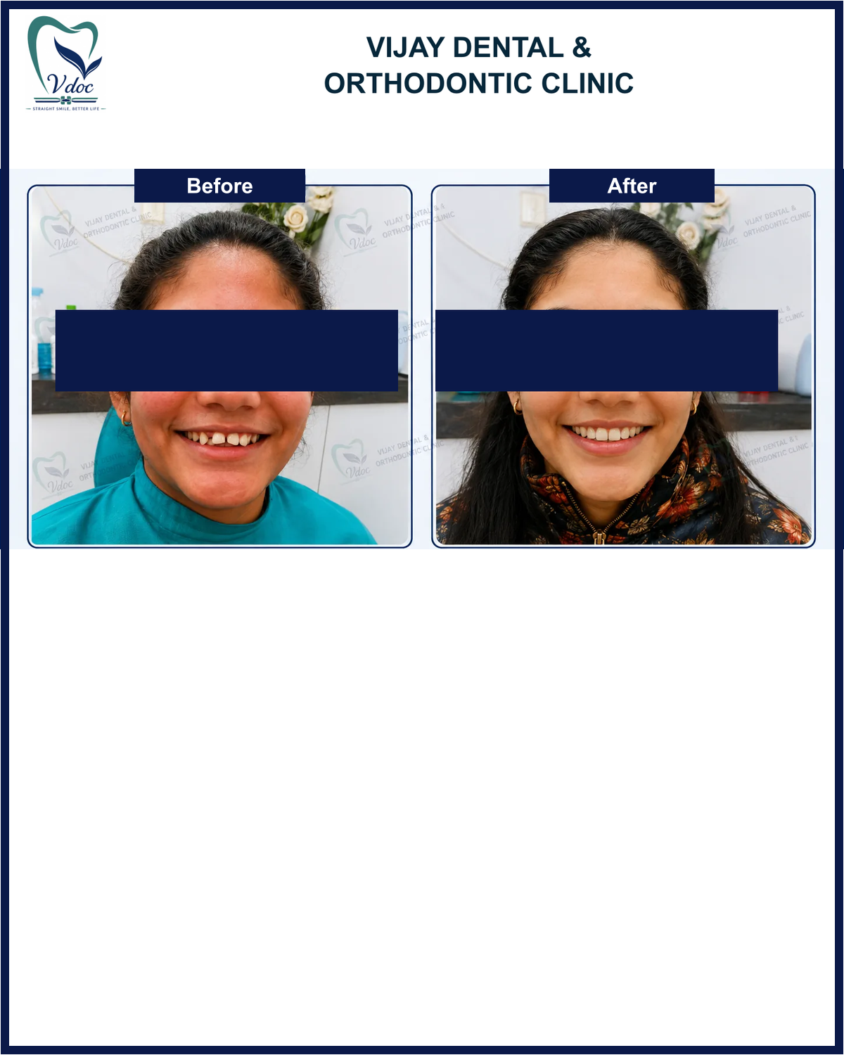 Pre and post smile correction at Vijay Dental and Orthodontic Clinic