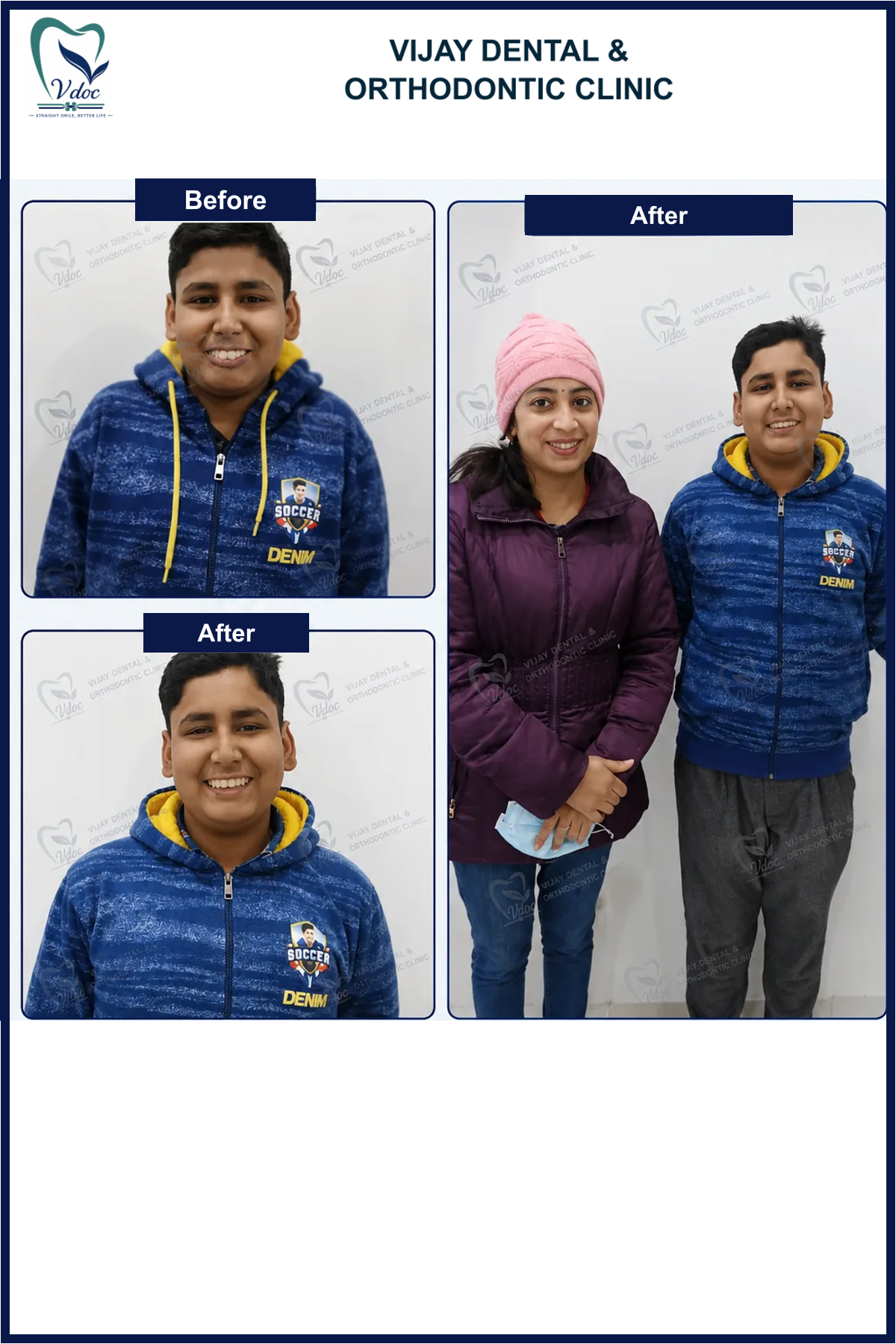 Pre and post young smile correction at Vijay Dental and Orthodontic Clinic