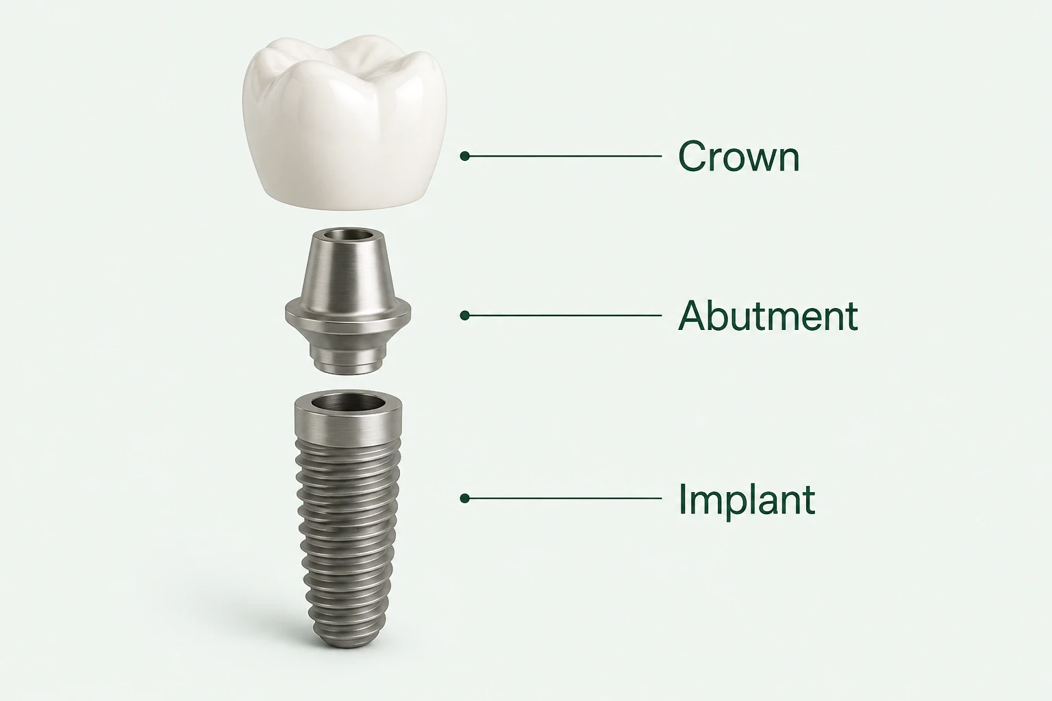 Educational illustration of three aligned components: a white crown above a connecting abutment and a threaded dental implant