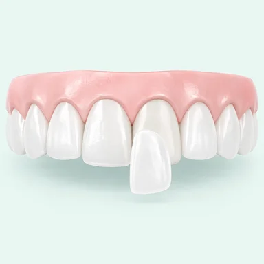 Porcelain veneer and natural white teeth illustration
